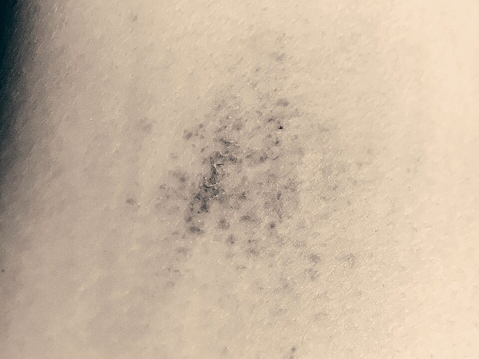 a black and white photo of a person's stomach